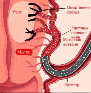 Эмболизация миомы матки