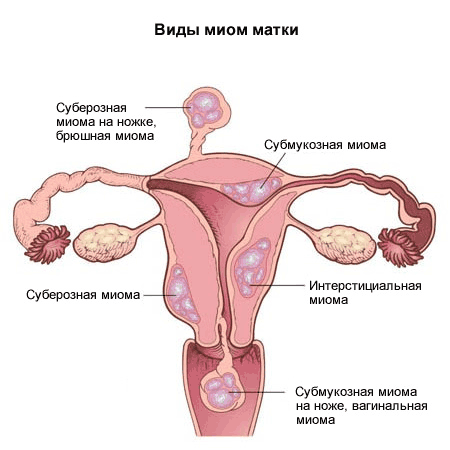 Виды миом матки